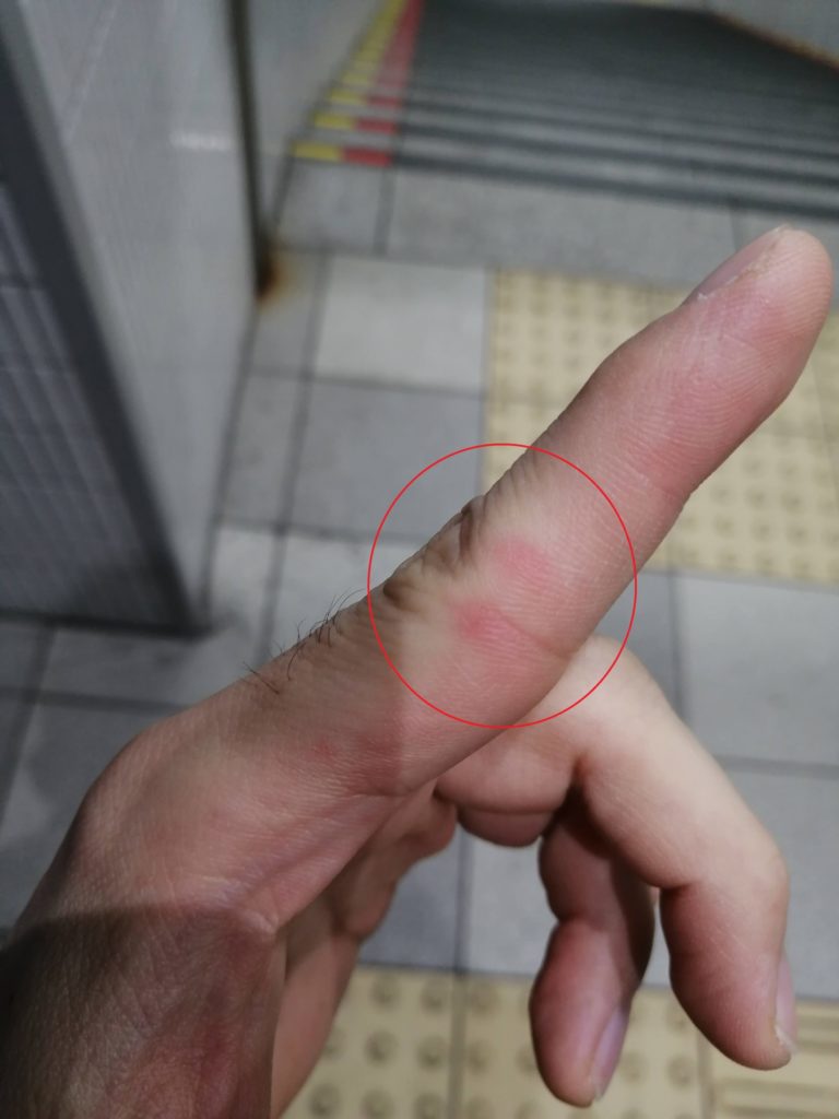 バレーコードを押さえ続けてできた指の赤み。人差し指側面第二関節周辺に１弦と２弦の痕がついている画像